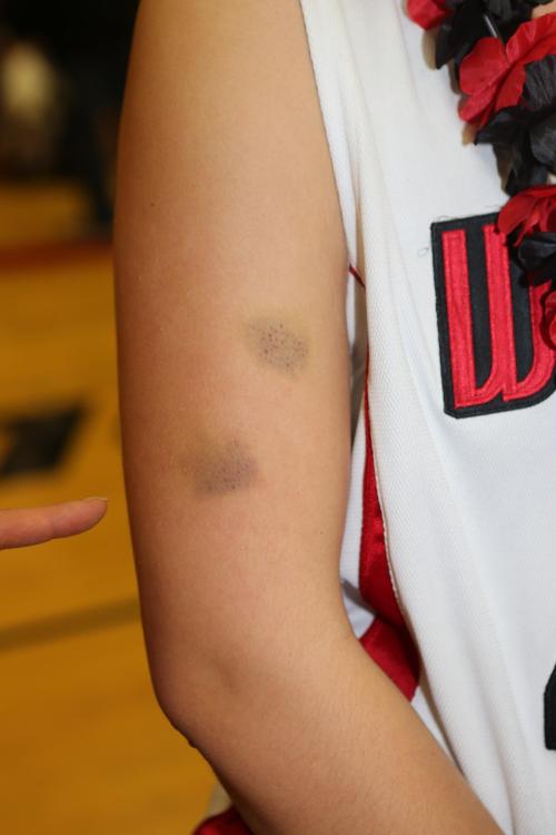 Bessie Walstad sports war wounds. (John Fisken photo)