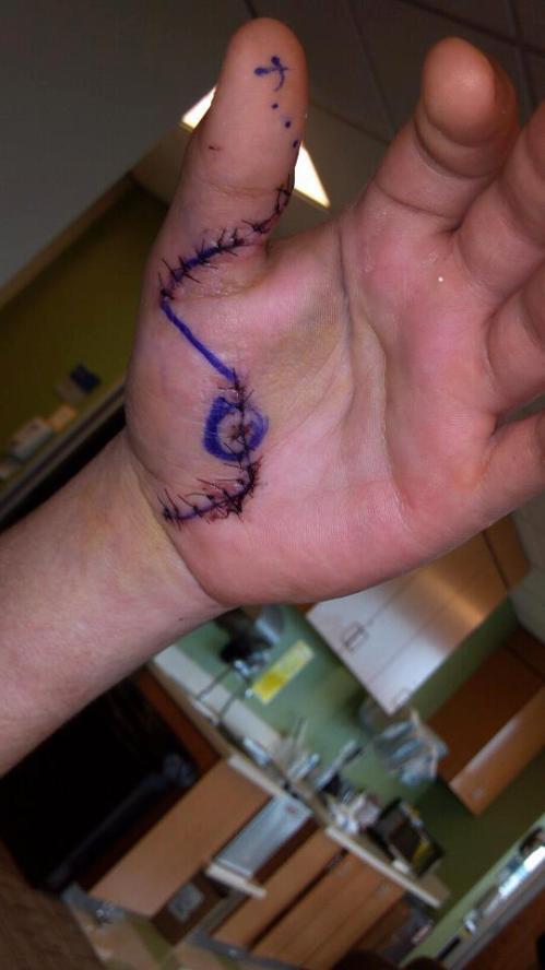 It lives! After surgery to repair a severed tendon in his thumb, Wolf baseball player Brian Norris has a conversation starter.