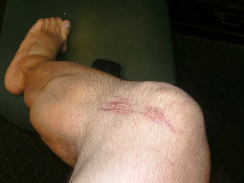 There goes my career as a knee model.