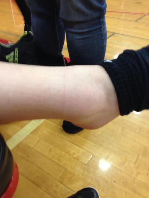 Hammer's ankle after the game. (Linda Hammer photo)
