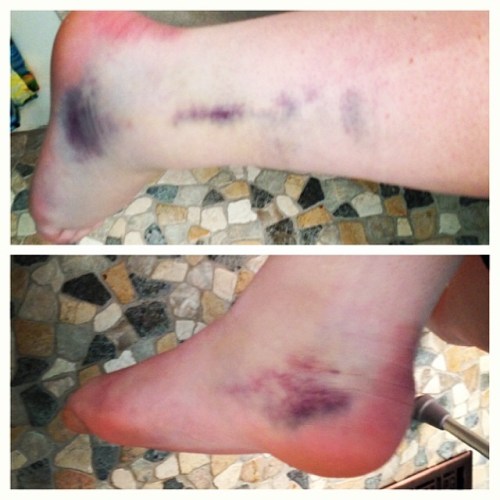 Hailey Hammer's ankle, now in vivid color.