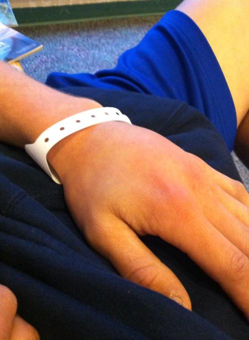 The injured hand. (Joan Payne photo)