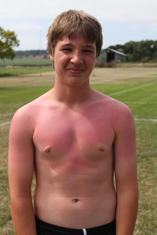 Someone may have forgotten to use sun screen...