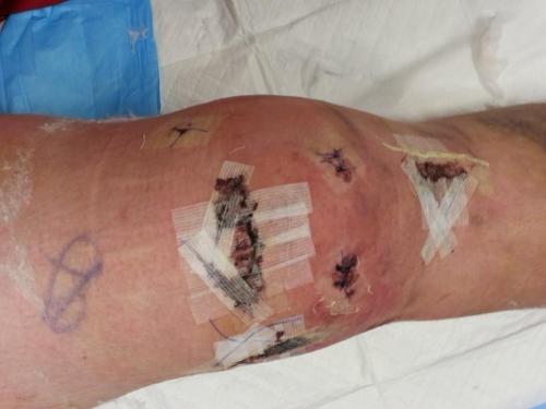 Former Wolf QB Gunnar Langvold's knee, post surgery.