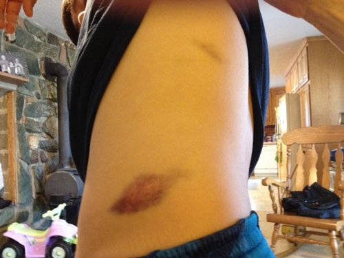 Matthew Kelley sports a reminder that football is a contact sport. (Pat Kelley photo)