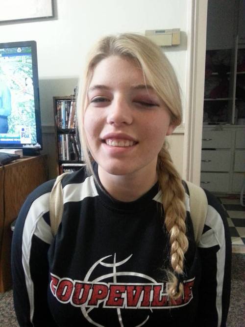 A shiner? Tiffany Briscoe, still smiling after catching a ball with her face during a recent practice. (Photo courtesy Amy Briscoe)