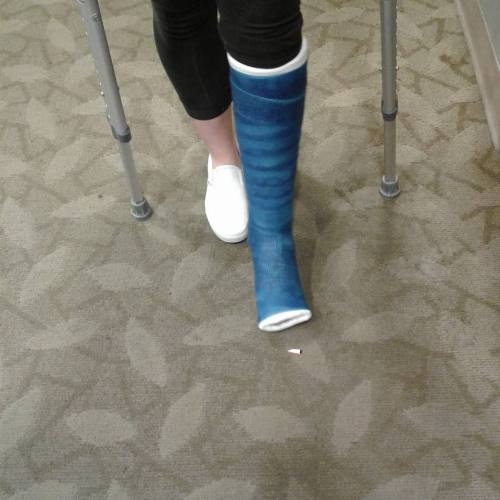 Briscoe models her new cast Monday. (Amy Briscoe photo)